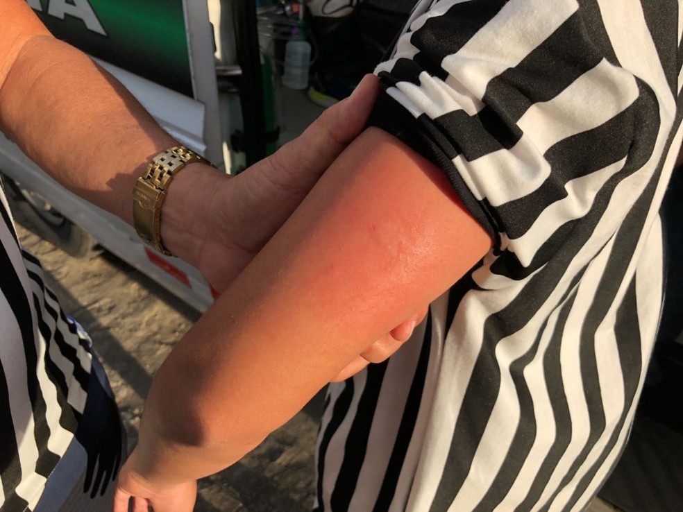 CrianÃ§a machucou o braÃ§o esquerdo apÃ³s uma das explsÃµes das bombas (Foto: Lucas Barros / TV Cabo Branco)