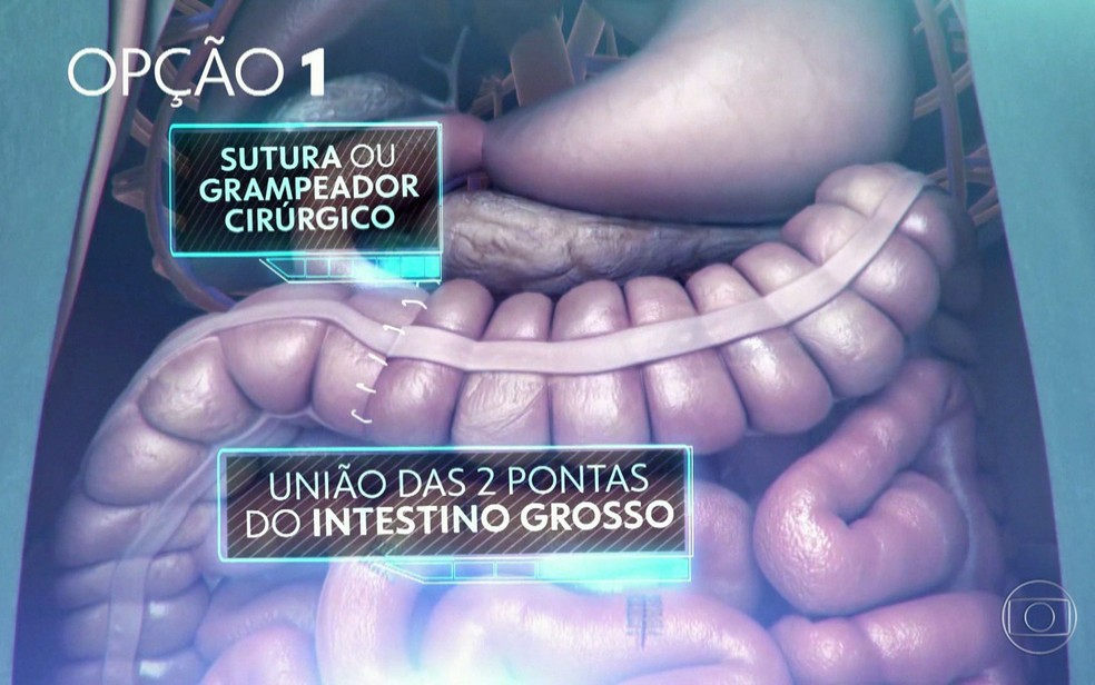 Uma opÃ§Ã£o dos mÃ©dicos Ã© unir as duas pontas do intestino grosso de Bolsonaro â€” Foto: TV Globo/ReproduÃ§Ã£o