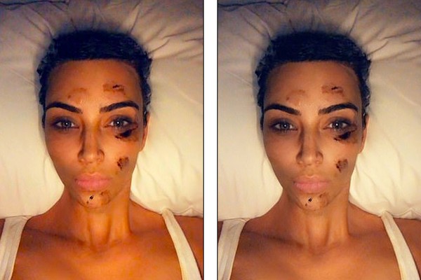 A foto compartilhada por Kim Kardashian mostrando o tratamento dela contra psoríase (Foto: Instagram)