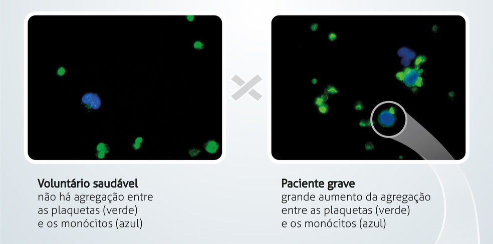 Imagens mostram diferença na agregação entre plaquetas e monócitos de uma pessoa saudável e um paciente com caso grave de Covid-19 — Foto: Divulgação/Fiocruz