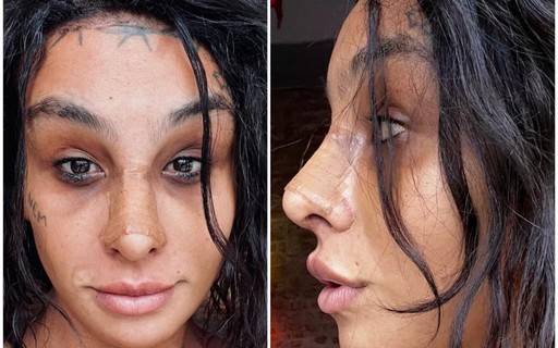 Linn da Quebrada mostra resultado de cirurgia de feminilização - QUEM Acontece