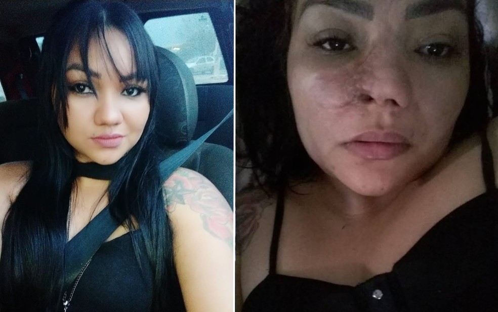 Antes e depois de cirurgia no nariz de Elielma Carvalho Braga — Foto: Elielma Carvalho/Arquivo Pessoal