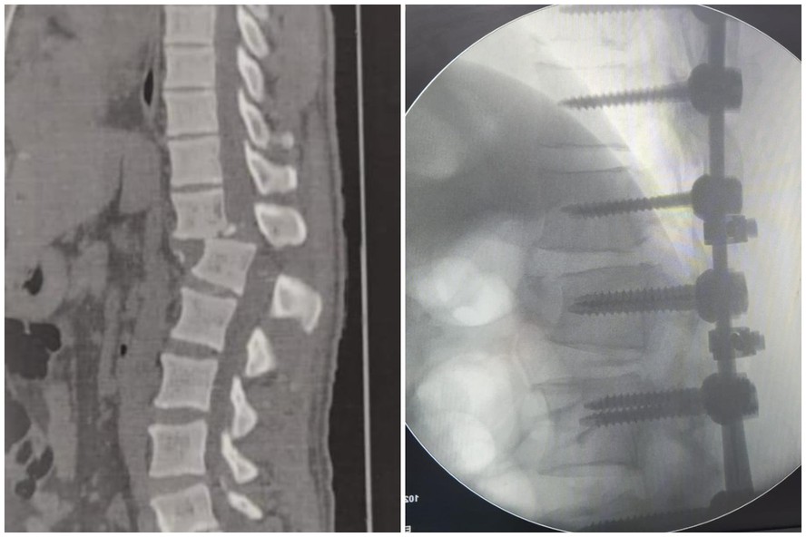 Regilânio da Silva Inácio, de 42 anos, passou por cirurgia para realinhar a coluna vertebral