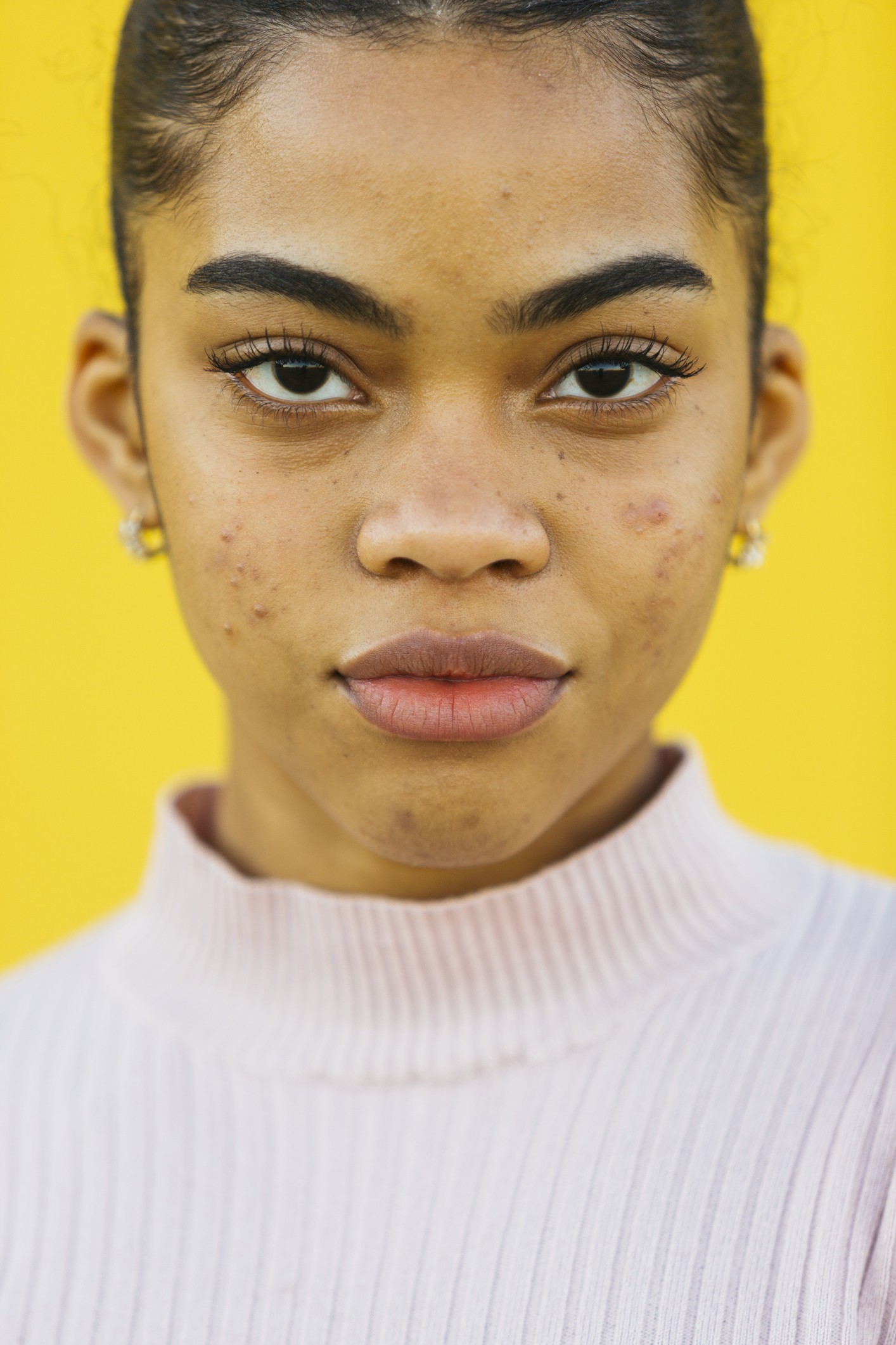 Pandemia na pele: acne adulta (Foto: Getty Images)