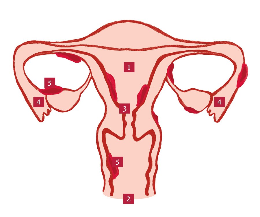 A endometriose ocorre quando partes do endométrio se alojam em órgãos do corpo. Entenda com a imagem  (Foto: Ilustração: UInverso)