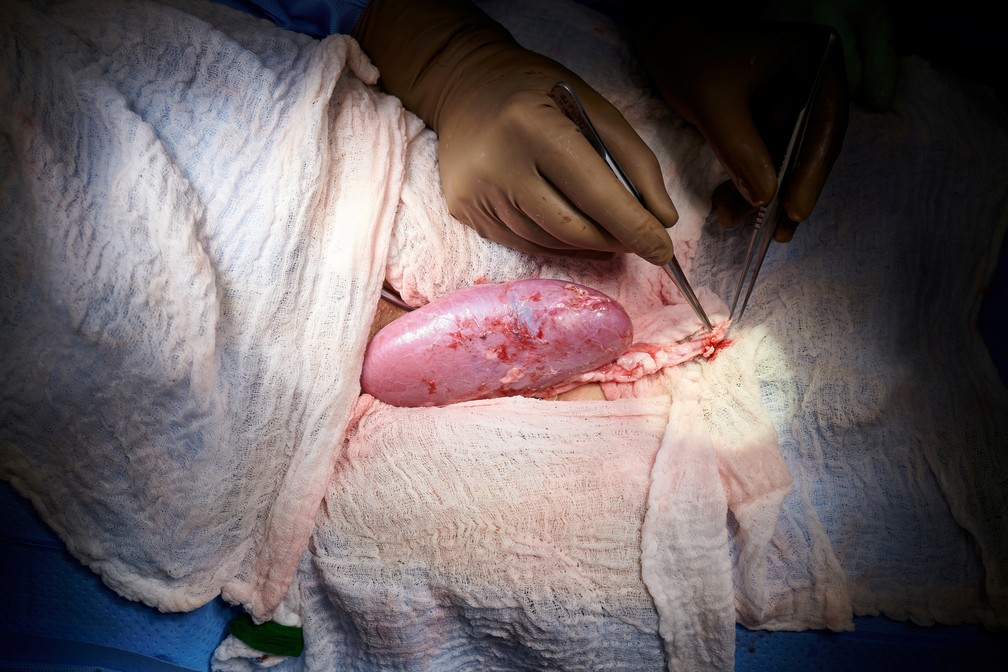 Em feito inédito, cirurgiões dos EUA testam com sucesso transplante de rim de porco em humano 12