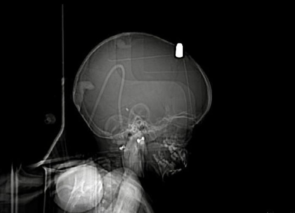 whatsapp-image-2022-09-29-at-08.04.00 Raio-x mostra bala alojada em cérebro de bebê de 1 ano na PB