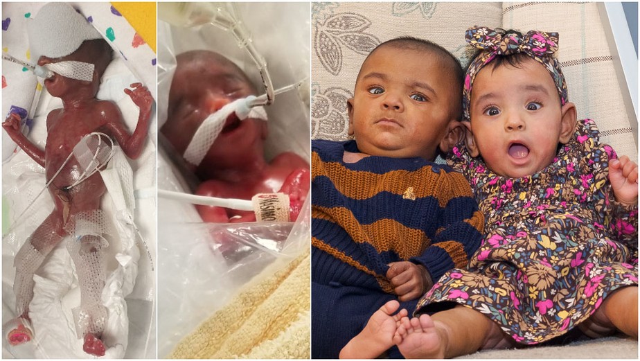 Gêmeos que nasceram de 21 semanas quebram recorde e completam 1 ano