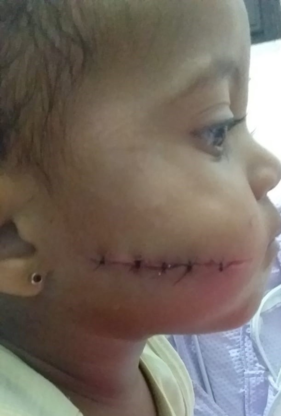 Criança de 1 ano e 6 meses fica ferida na bochecha por linha com cerol em Iguaba Grande, no RJ — Foto: Arquivo pessoal