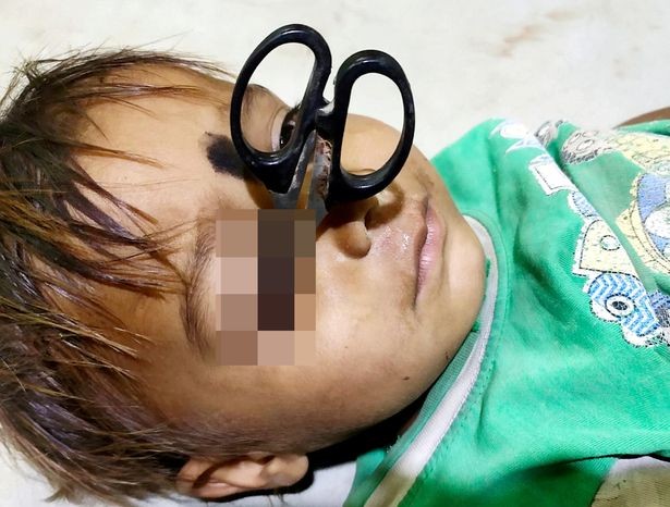 Menino de 3 anos espeta tesoura no rosto, a poucos milímetros do olho -  Revista Crescer | Saúde