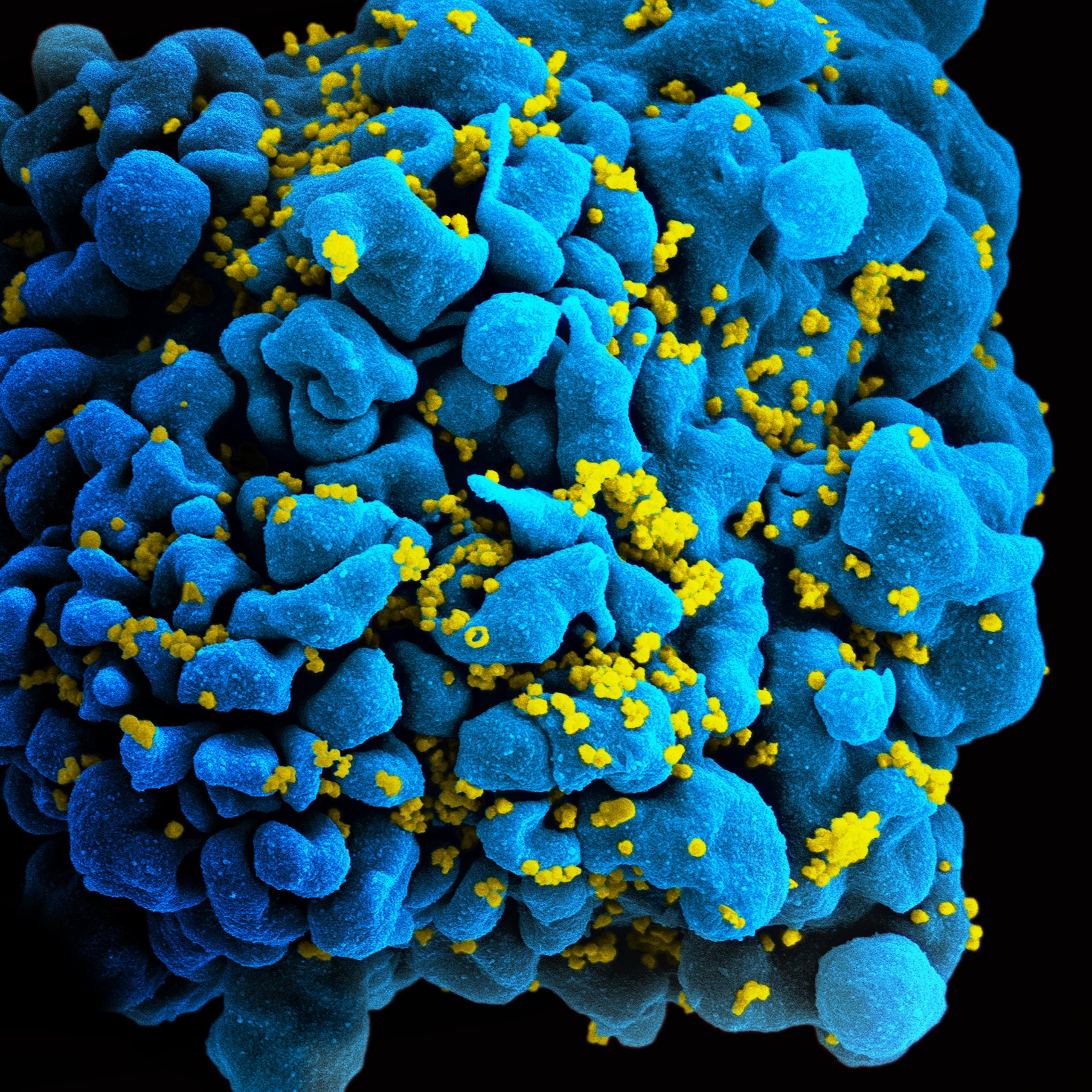 Estudo explica como metabolismo da glicose pode revelar esconderijo do HIV (Foto: Instituto Nacional de Alergia e Doenças Infecciosas dos EUA (NIAID))