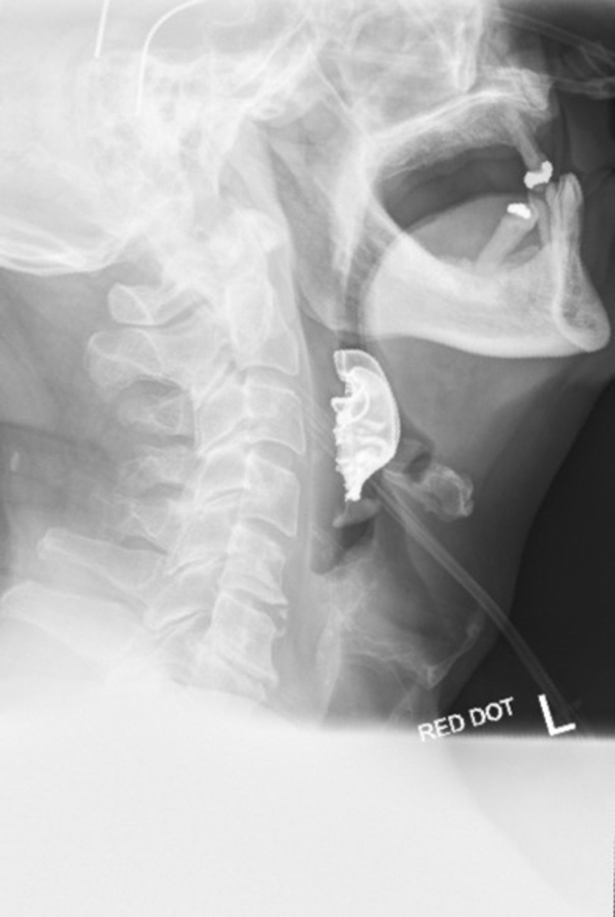 Raio-X revelou prótese dentária presa na laringe do paciente (Foto: BMJ Case Reports)