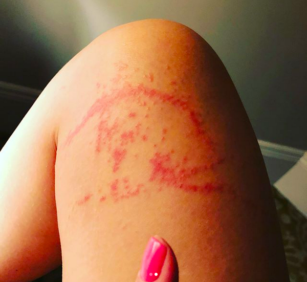 A queimadura de Katy Perry após o contato com uma água-viva (Foto: Instagram)