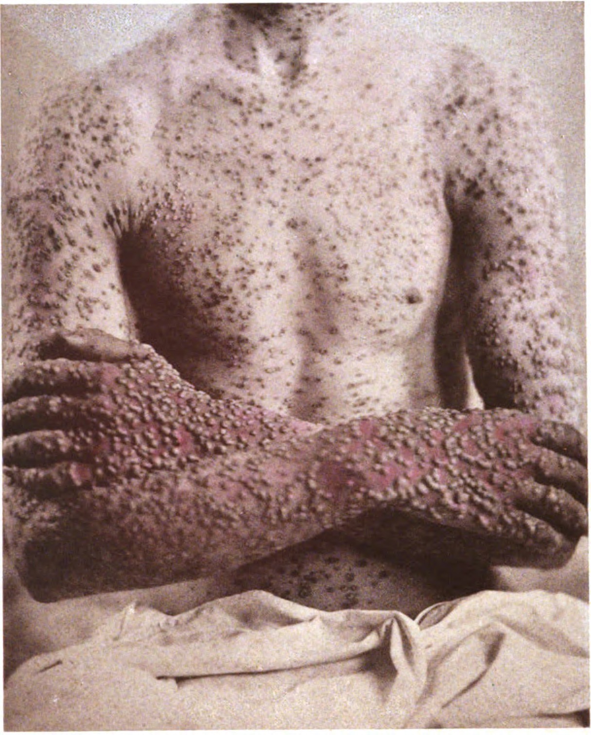 Paciente de varíola, fotografado em 1886. A doença, muitas vezes fatal, foi  erradicada em 1979. (Foto: wikimedia commons)