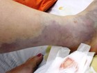 Mulher que sofreu acidente com bagre e quase amputou perna recebe alta