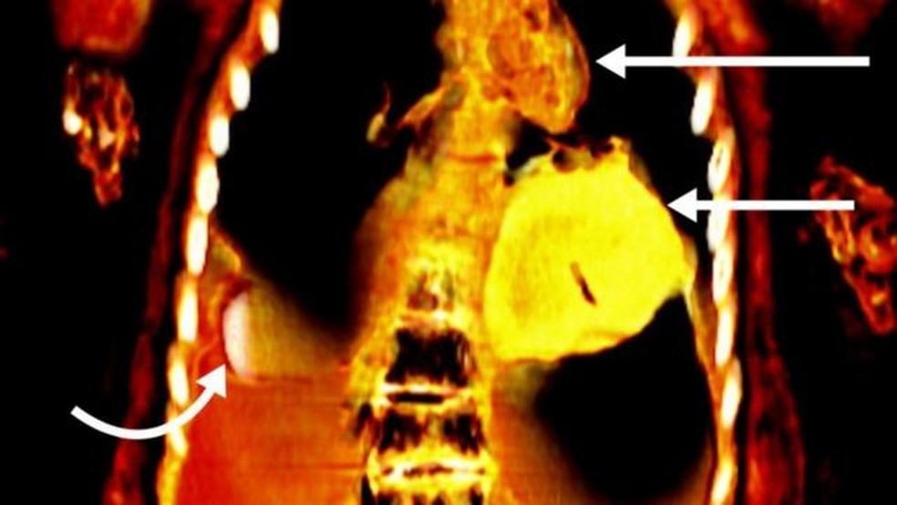 Imagem de tomografia mostra o coração de ouro da múmia — Foto: Cortesia s.n. Saleem, s.a. Seddik, m. El-halwagy/Via BBC