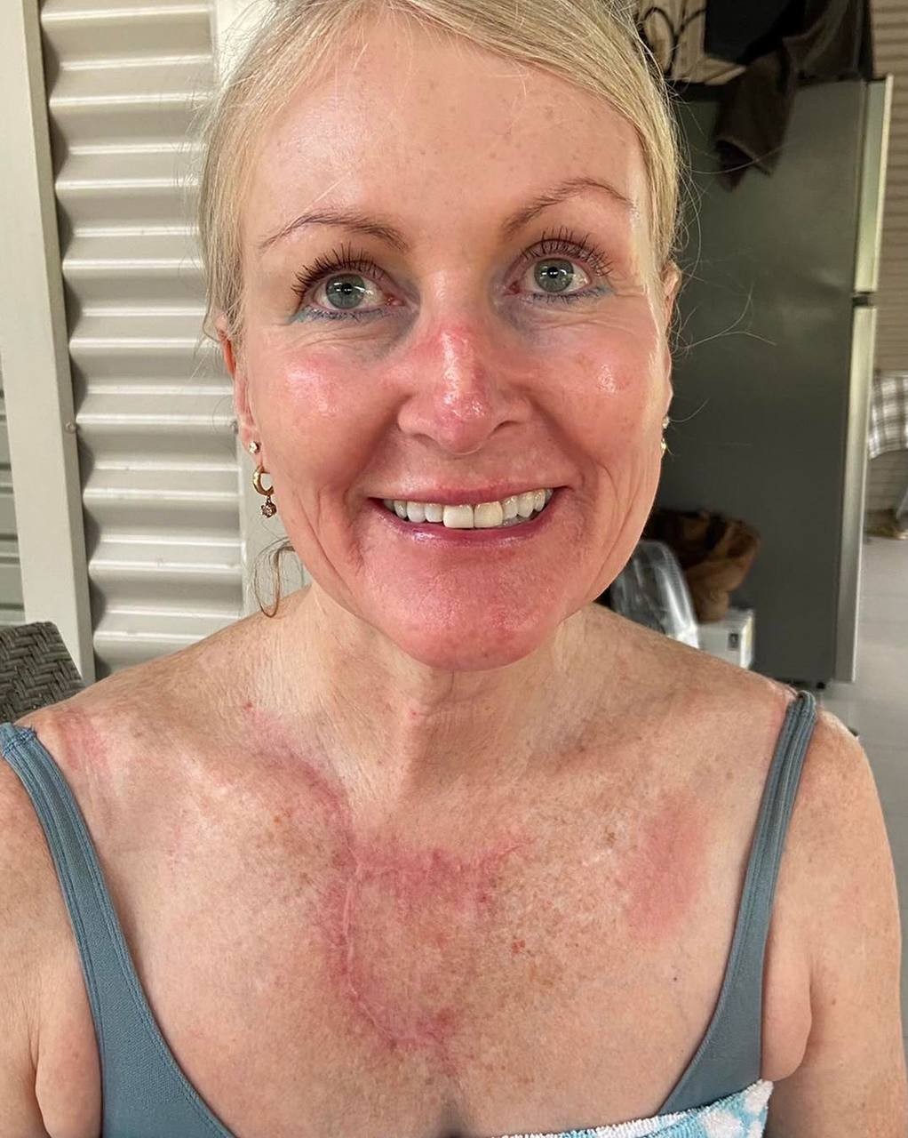 Jillian Murray descobriu o câncer de pele após tratamento estético (Foto: Reprodução / NY Post, facebook)