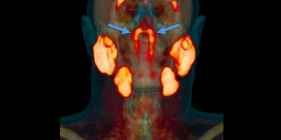 As novas glândulas ficam atrás do nariz, no encontro com a garganta — Foto: VALSTAR, ET. AL./RADIOTHERAPY AND ONCOLOGY via BBC