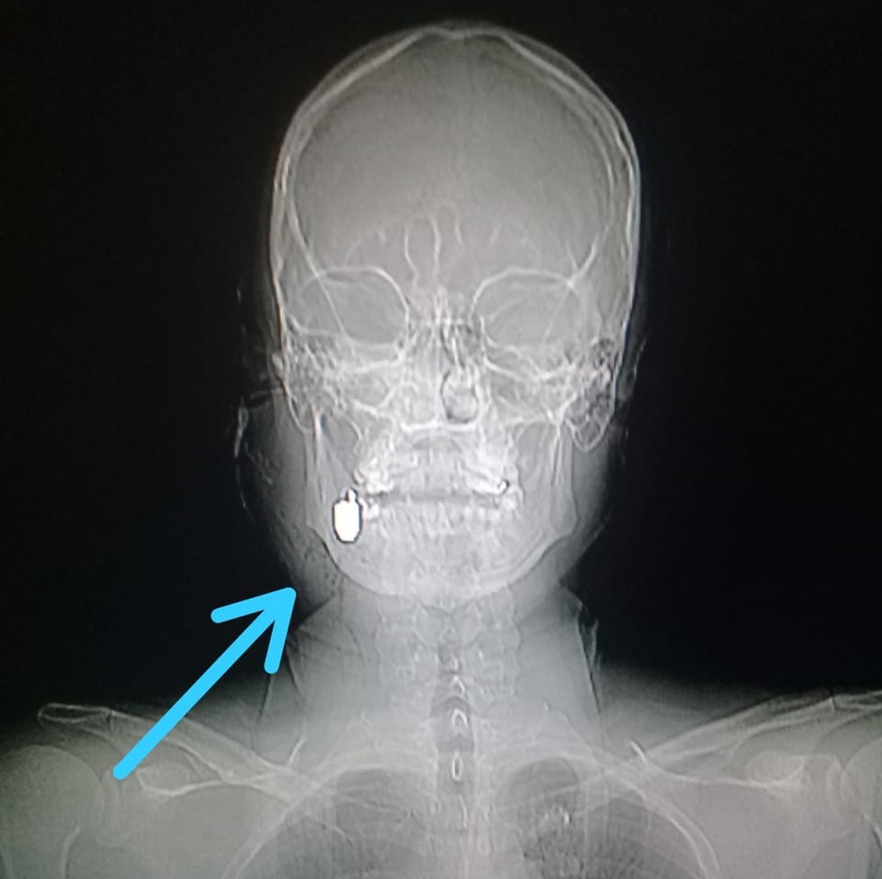 Homem foi atingido por uma bala no nariz, que percorreu a face e chegou ao pesco&ccedil;o &mdash; Foto: Arquivo Pessoal