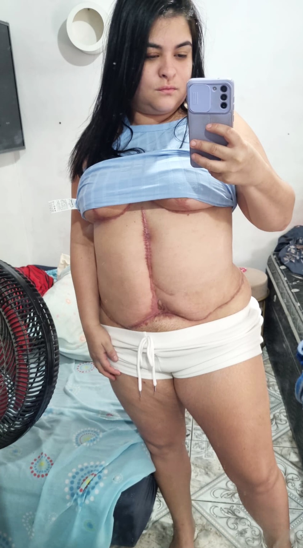 Daiana Chaves: feridas fecharam e ela agora torce por uma cirurgia reparadora — Foto: Arquivo pessoal