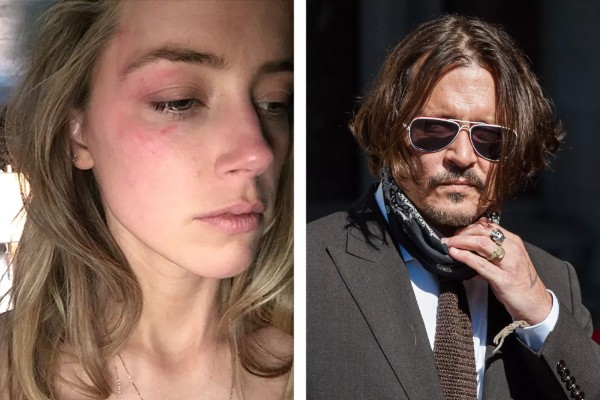 Amber Heard com machucados após as supostas agressões de Johnny Depp (à esq); Johnny Depp (à dir.) nega acusações (Foto: reprodução; Getty Images)