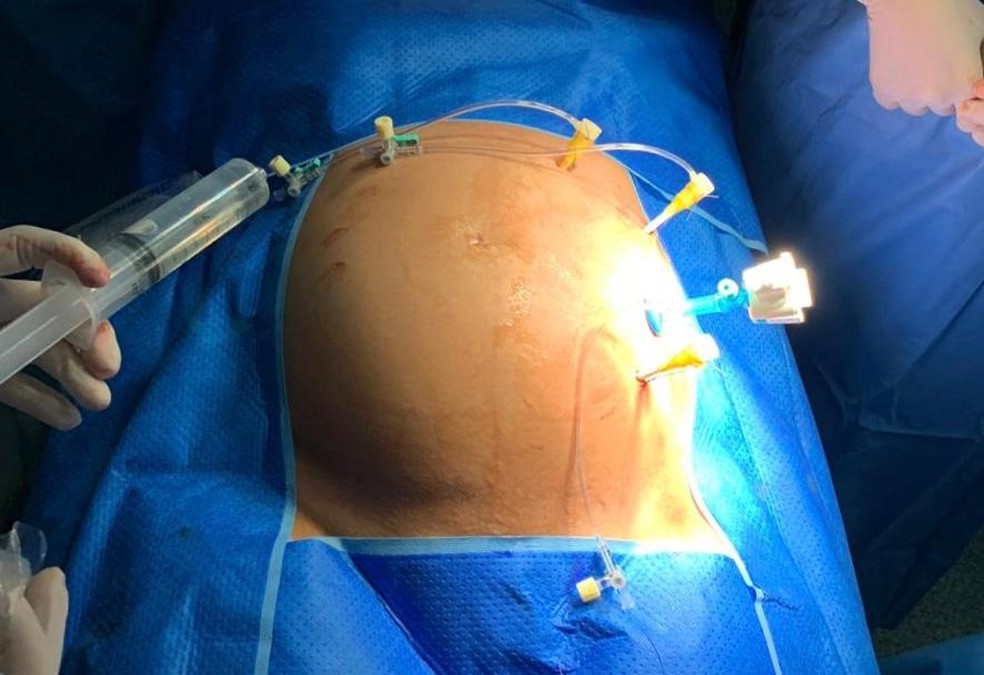 Procedimento cirúrgico é feito dentro da barriga da mãe  — Foto: Arquivo Pessoal 