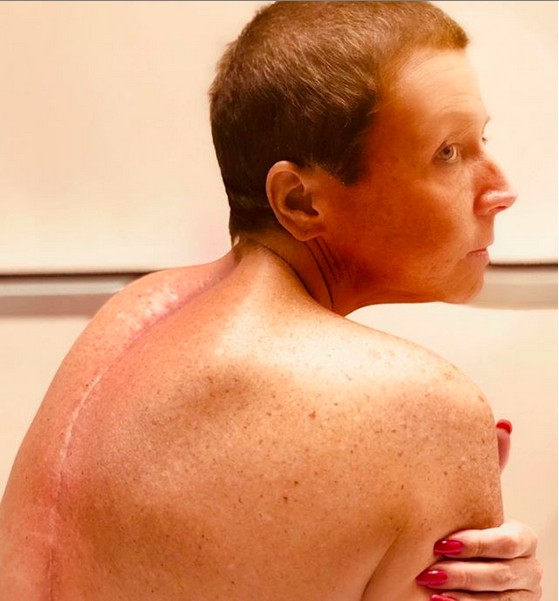 A foto compartilhada por Abby Lee Miller mostrando a cicatriz nas costas delas (Foto: Instagram)