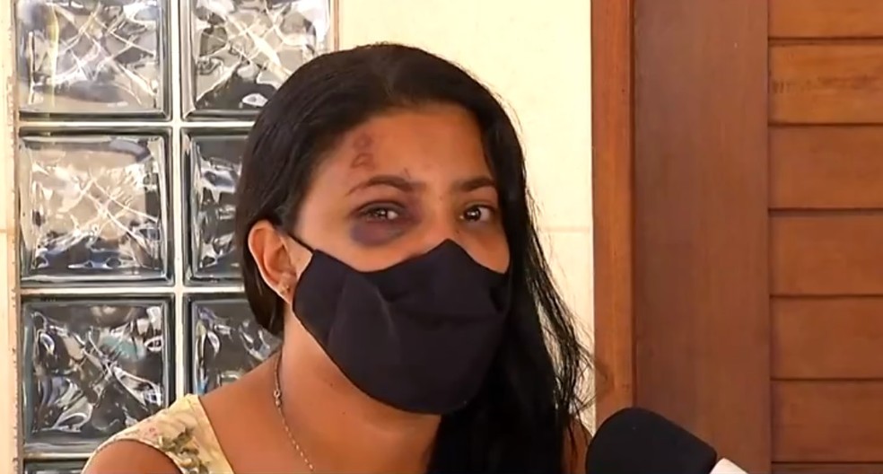 Natália Abade ficou com vários hematomas no rosto e no corpo por conta das agressões — Foto: Reprodução/Inter TV Cabugi