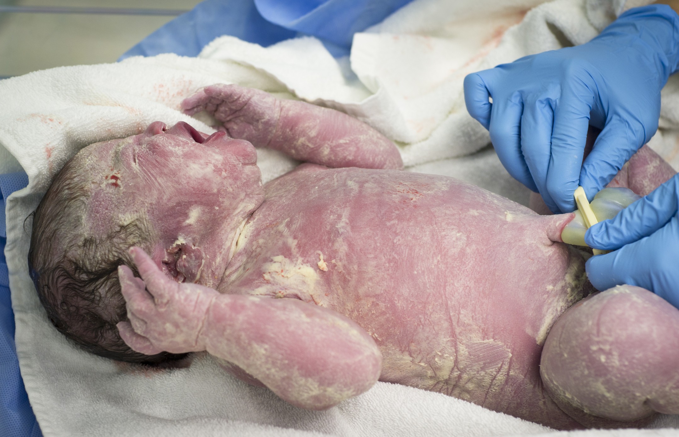 Recém-nascido coberto por vernix (Foto: Thinkstock)