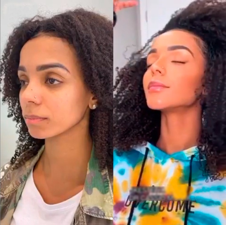 Brunna Gonçalves faz harmonização facial (Foto: Reprodução/Instagram)