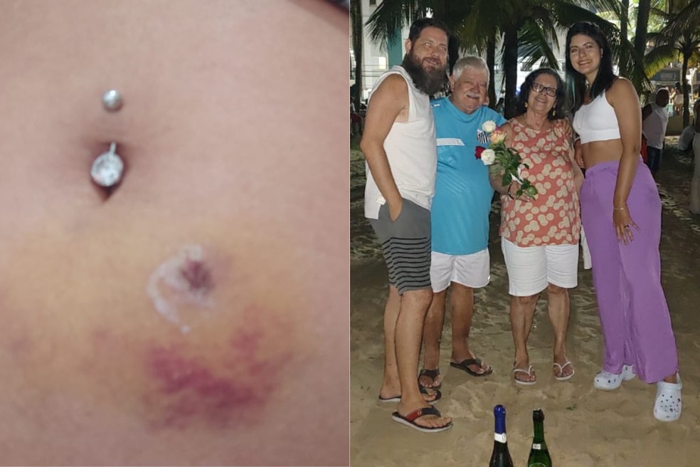 Pedagoga ficou com a barriga ferida após ter sido atingida por fogos de artifício, na noite do último sábado (31), em Praia Grande — Foto: Arquivo Pessoal