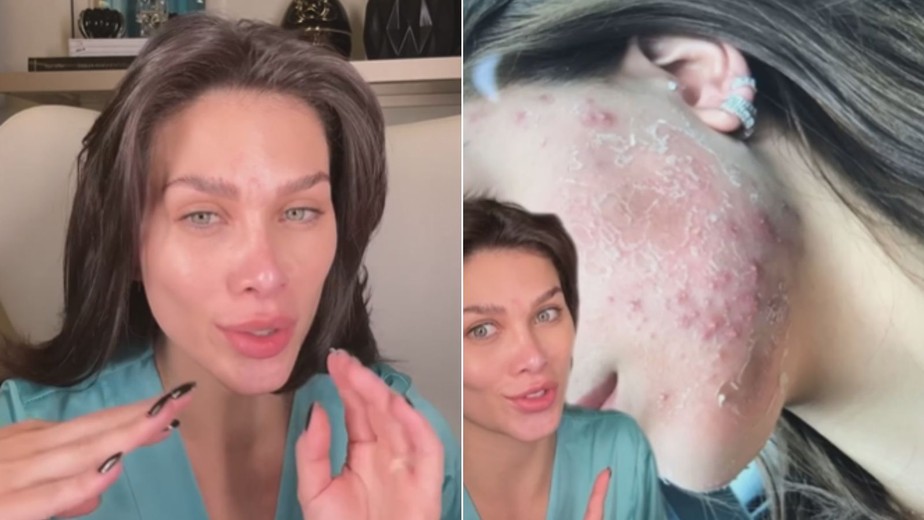 Flavia Pavanelli enfrentou problemas com acne por seis anos
