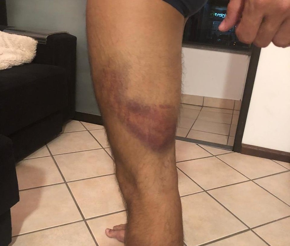 Homem ficou com marcas de cassetete no corpo — Foto: Gustavo Costa Bernardo/Divulgação