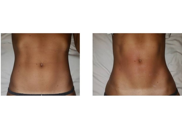 Esteticista mostra antes e depois da barriga de Ewbank, pós "massagem milagrosa" (Foto: Reprodução/Instagram)