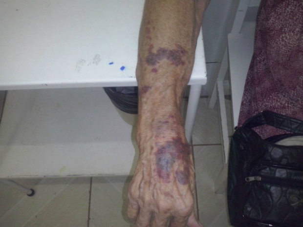 Idosa teve escoriações nos braços e rosto devido as agressões (Foto: Divulgação/Polícia Militar de Manduri)