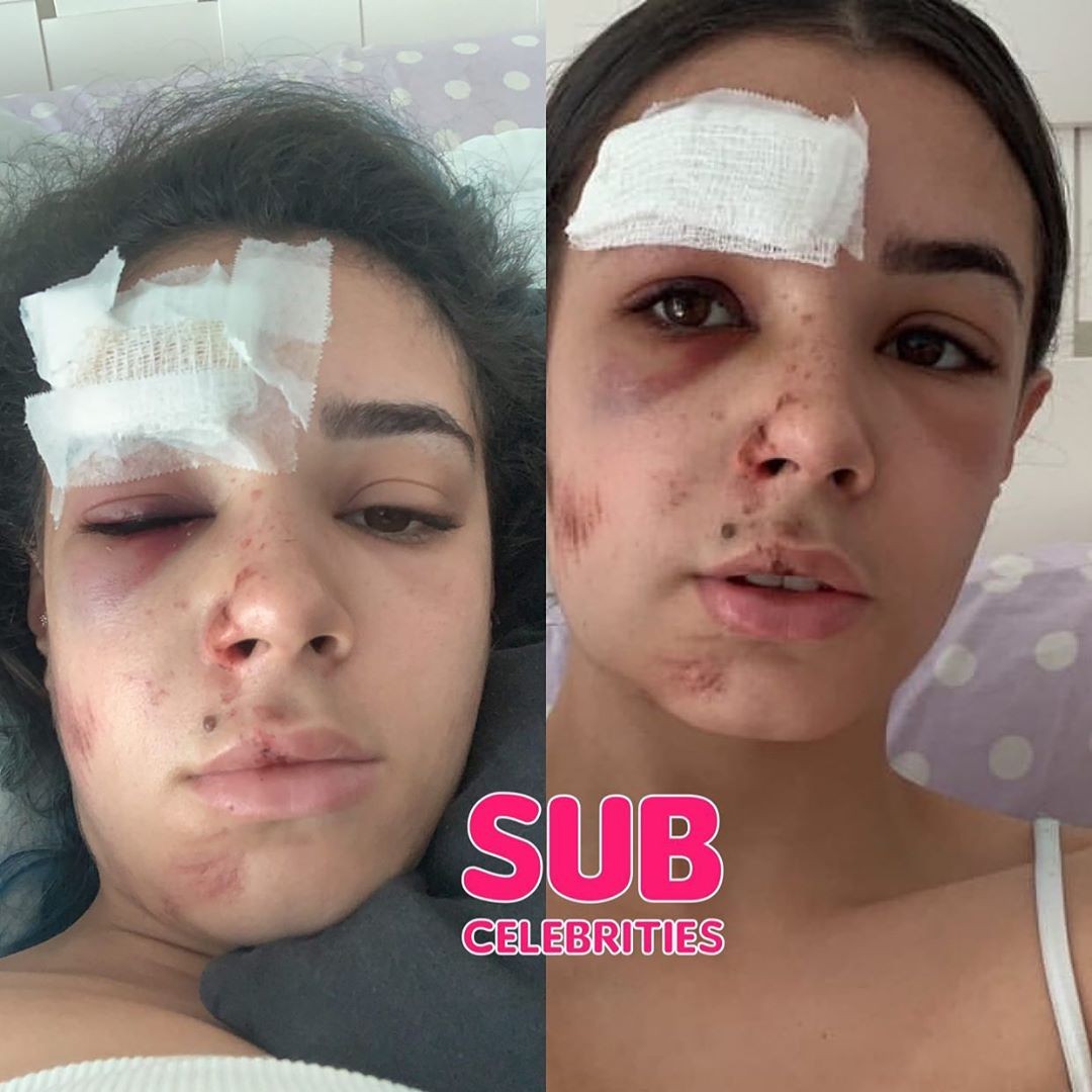 Jully Molina mostra ferimentos após acidente (Foto: Reprodução/ Instagram)
