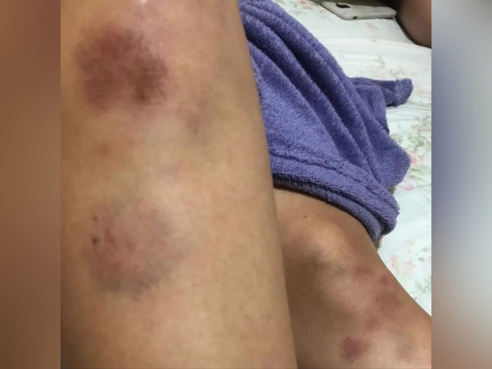 Vítima passou por exame de corpo de delito e recebeu uma medida protetiva de urgência contra o ex-namorado. — Foto: Arquivo pessoal