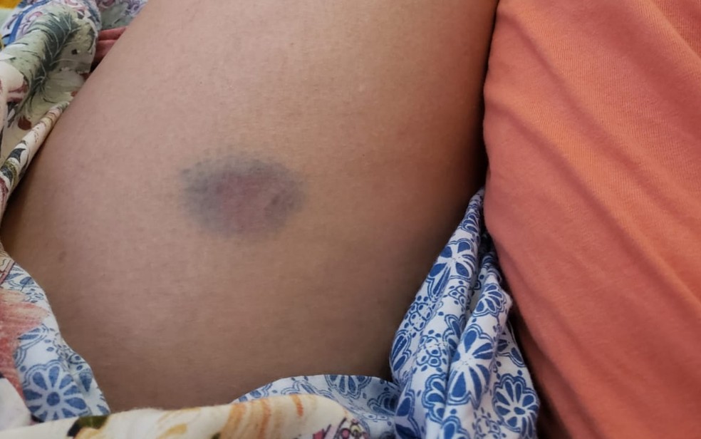 Um dos ferimentos que a médica registrou enquanto tentava separar ex-namorado de amigo — Foto: Reprodução/TV Anhanguera