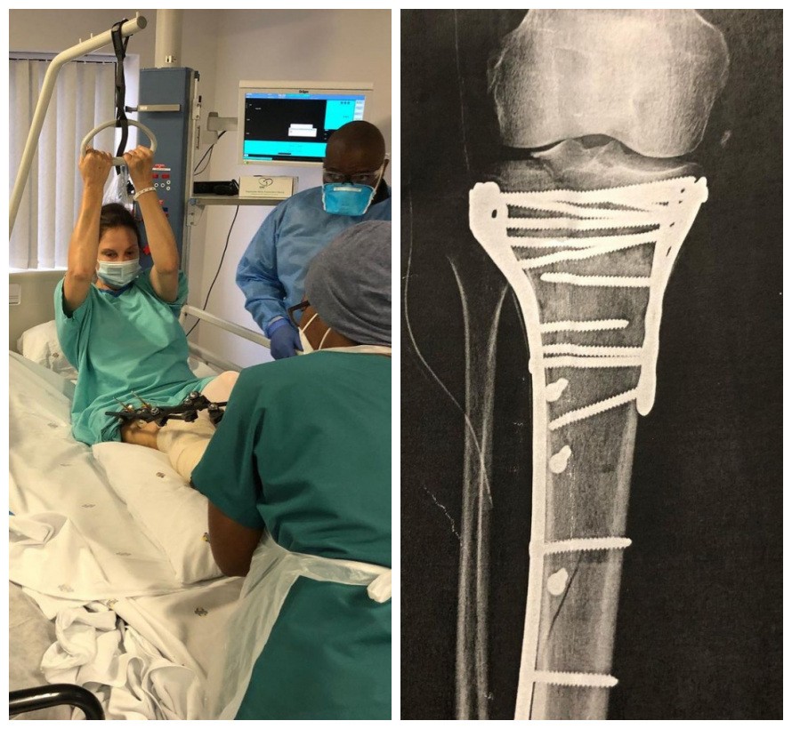 Ashley Judd na cama de hospital e o raio x da sua perna (Foto: Reprodução/Instagram)