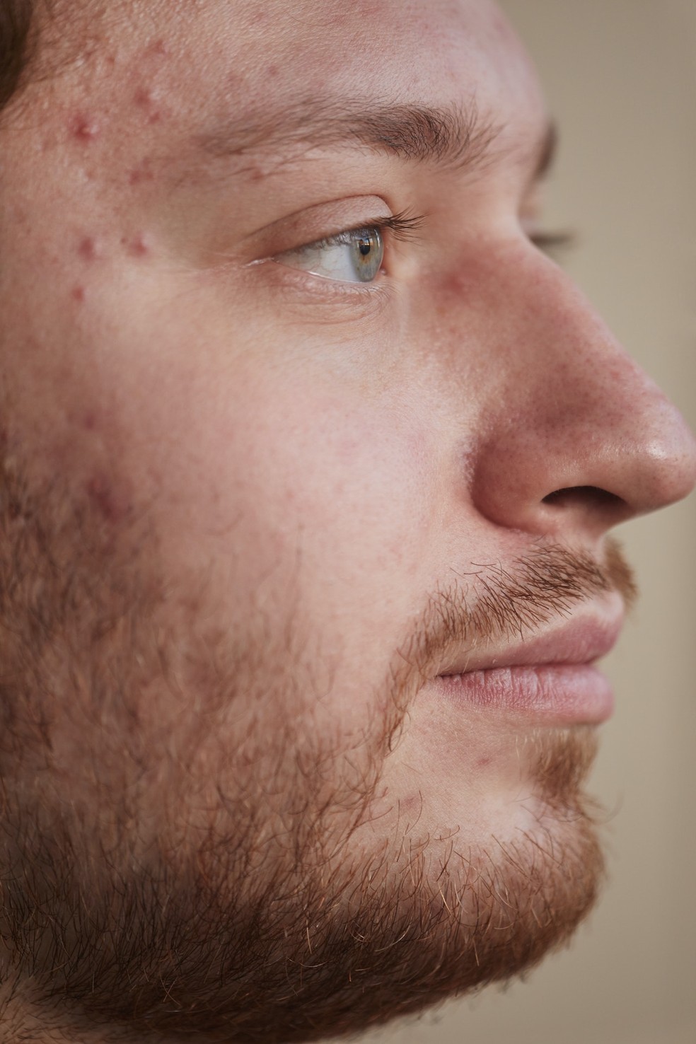 Em alguns casos, a acne pode vir acompanhada de vermelhidão e irritação da pele. — Foto: Reprodução/Pexels