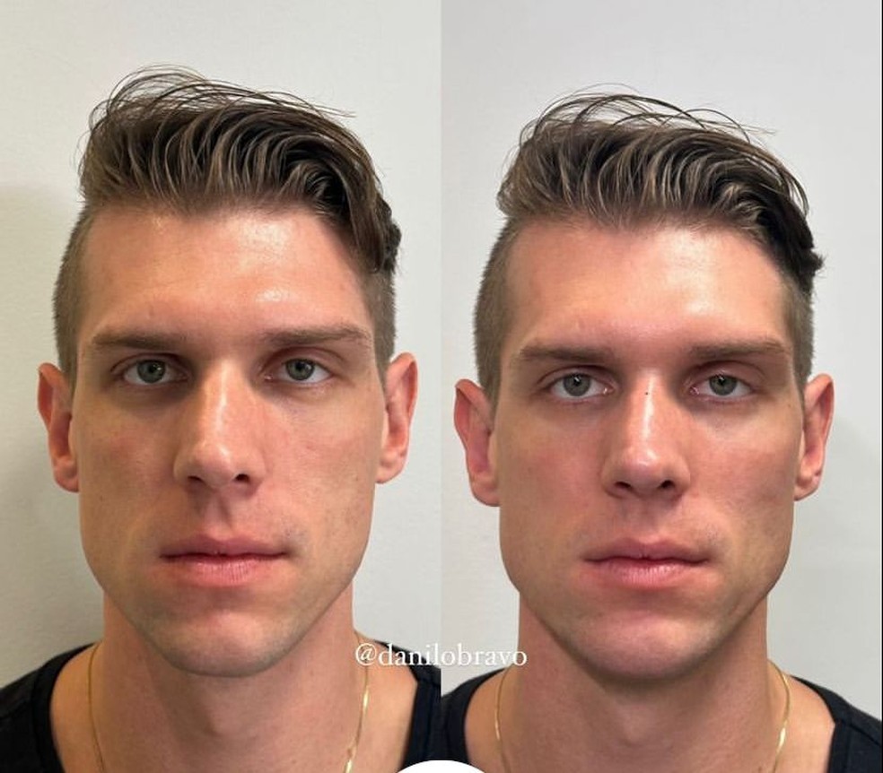 Fora do BBB 23, Cristian faz harmonização facial e compartilha resultado na  web | Internet ta vendo | gshow