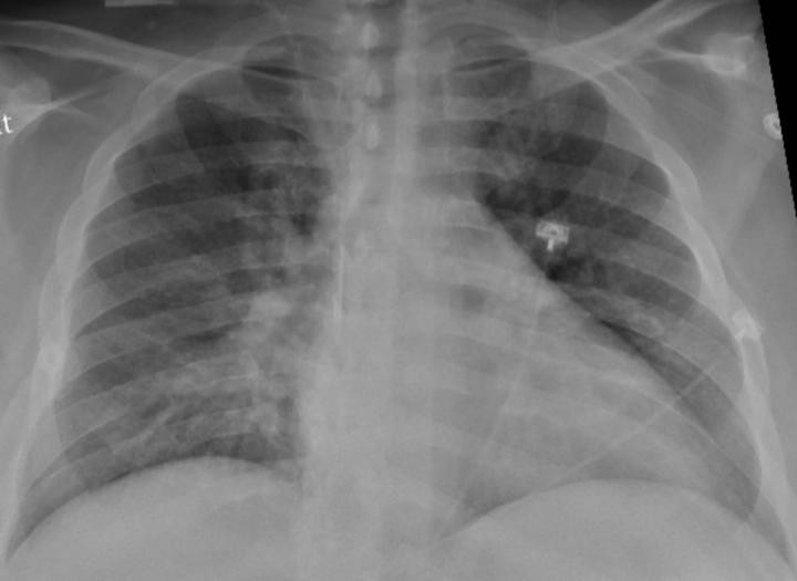 Paciente com covid-19 é identificado com pneumonia na parte inferior do pulmão  (Foto: Sociedade Radiológica da América do Norte)