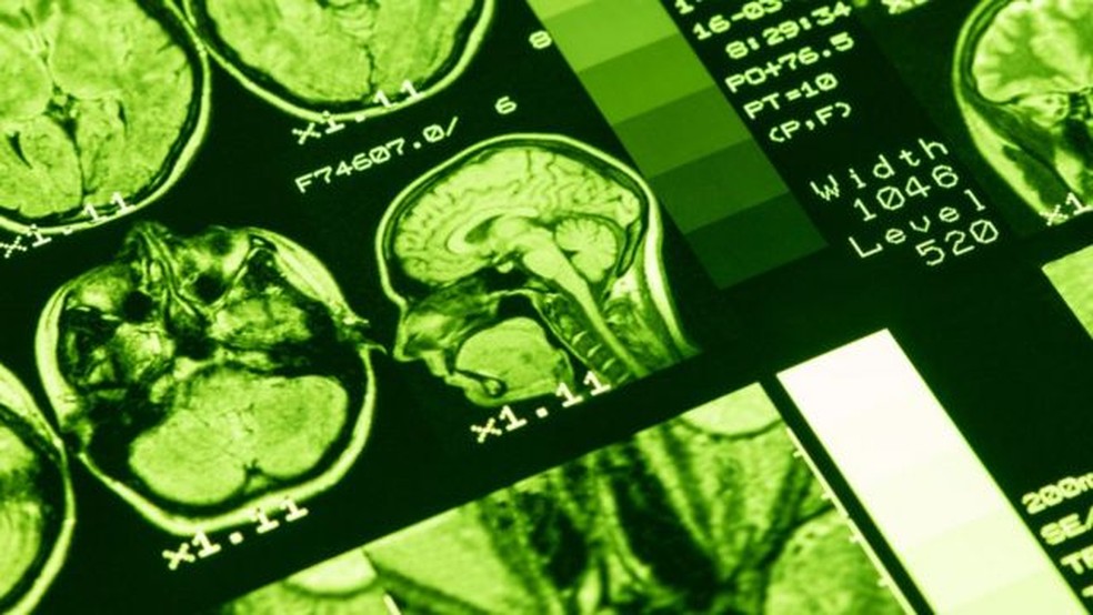 Imagem de ressonância magnética de cérebro — Foto: GETTY IMAGES/BBC