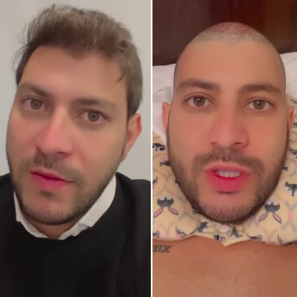 Caio antes e logo depois do transplante capilar — Foto: Reprodução/Instagram