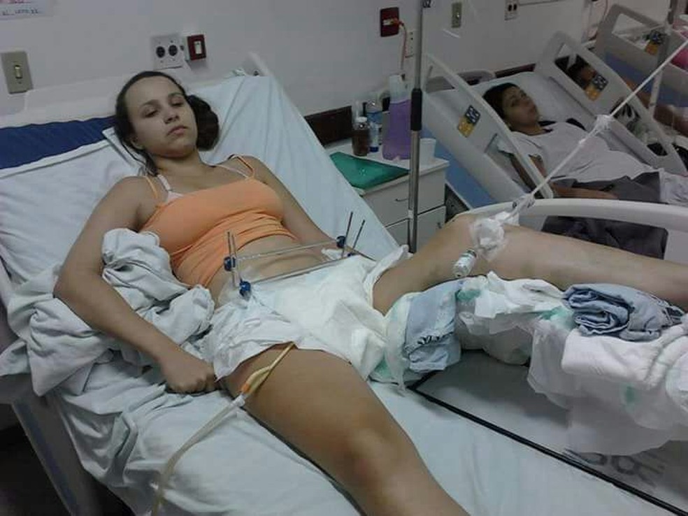 Thamires dos Santos Martins Pedro precisou passar por sete cirurgias após acidente de moto (Foto: Thamires dos Santos Martins Pedro/Arquivo Pessoal)