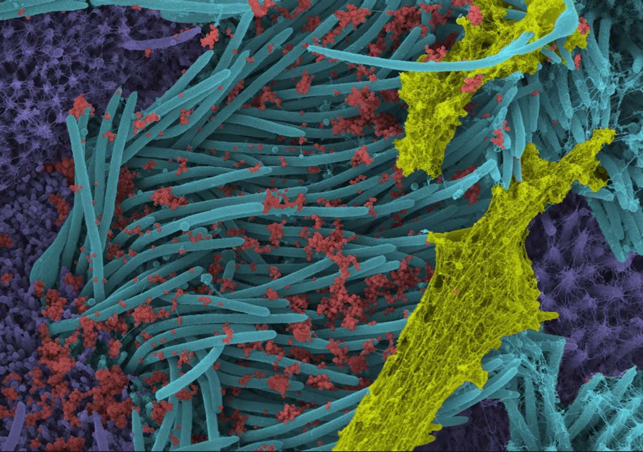 Cílios das células epiteliais (azul) tomados por partículas infecciosas do Sars-CoV-2 (vermelho) e muco (amarelo) (Foto: Ehre Lab, UNC School of Medicine)