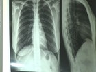 Núcleo de Controle registra 11 novos casos de tuberculose em Roraima