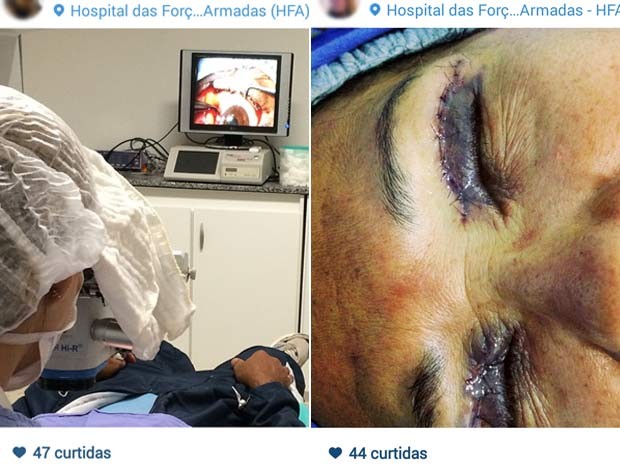 Na primeira imagem, oftalmologista faz cirurgia para retirada de membrana de olho em Brasília; na segunda, paciente está com os olhos ainda inchados após plástica nas pálpebras (Foto: Instagram/Reprodução)