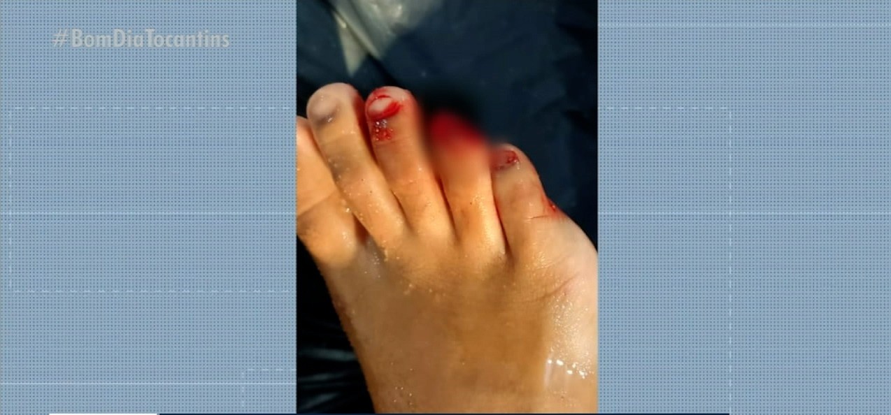 Banhista tem pedaço do dedo arrancado por piranha durante banho em lagoa