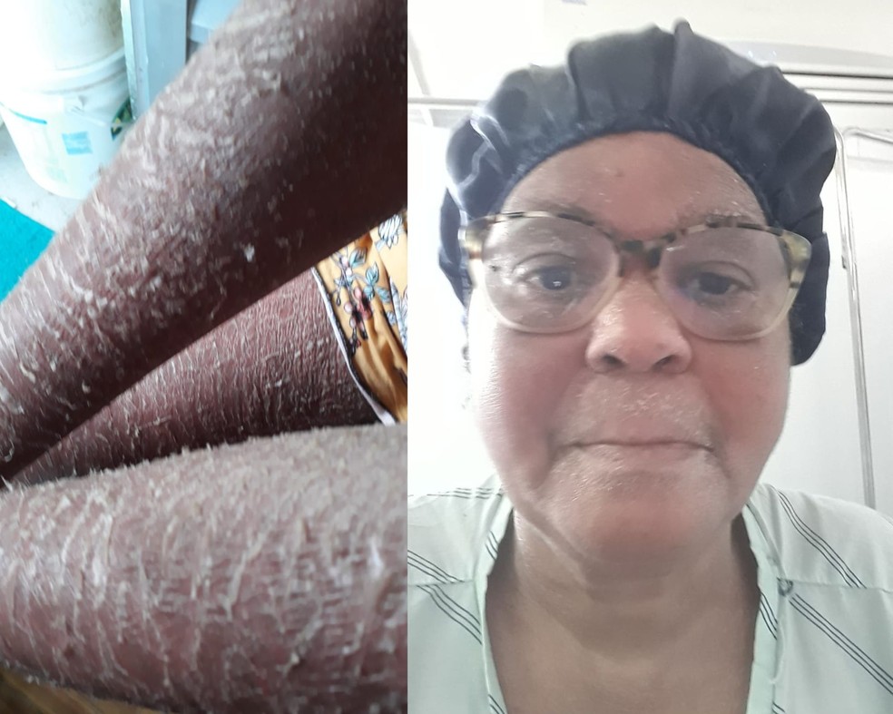 Mulher descobre leucemia e dermatite grave durante viagem; há anos ela sofria com coceira, manchas e descamações na pele